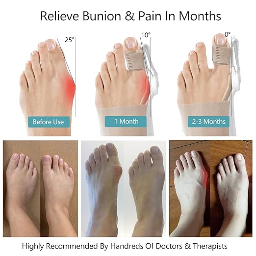 Toe Alignment Support & Bunion Relief Corrector